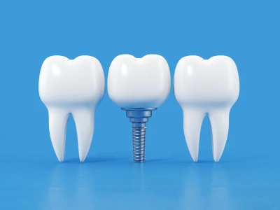 implante dental o puente, que es mejor(1)